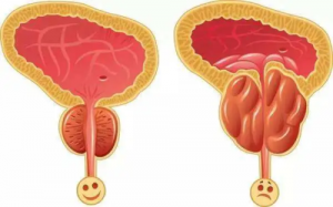 男性前列腺炎能过性生活吗？需要注意什么